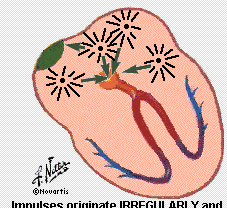 La dilatazione dell atrio di sinistra è generalmente secondaria a malattia mitralica o a dilatazione del VS ( cardiopatia dilatativa e/o ischemica ) RITMO ATRIALE ECTOPICO Tutte le onde P sono