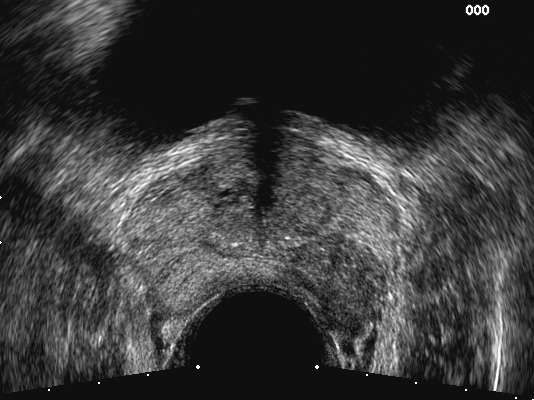 Ecografia Trans-Rettale Aspetto ecografico nodulo
