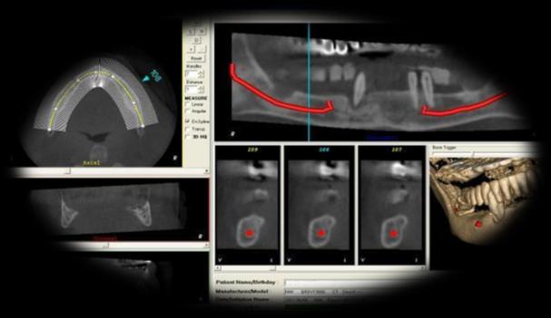 SIMULAZIONE DEL TRATTAMENTO IMPLANTARE Il clinico importa i dati radiologici in formato DICOM 3.0 dal CD consegnato dal paziente ed effettua la simulazione 3D del trattamento implantare.