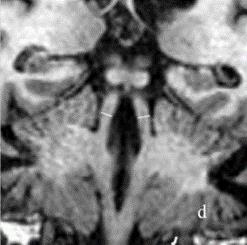 Applicazione in malattie neurodegenerative Tecniche di segmentazione manuale per la differenziazione la Paralisi Sopranucleare