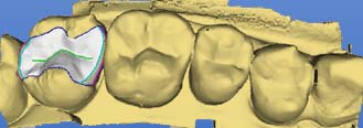 Determinare l'asse d'inserzione per il dente 15 (ved. "Rideterminazione dell'asse d'inserzione" [ 117]). 8. Fare clic sull'icona "Avanti". 9. Creare un restauro (ved.