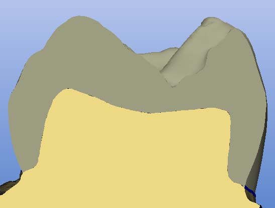 intervallo maggiore verde: Penetrazione 0-50 µm giallo: Penetrazione 50-100 µm rosso: Penetrazione >100 µm Con gli strumenti di Design "Scale", "Shape", "Form" oppure "Drop" è possibile creare le