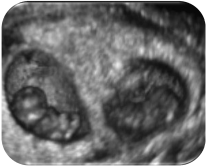 Altri fattori di rischio Malattie croniche (LES, anemie, emoglobinopatie) Malnutrizione severa Patologie della placenta (corionangioma, placenta praevia) Abuso di sostanze