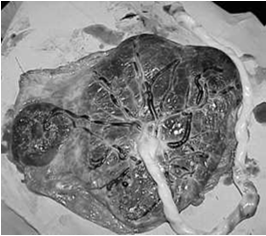 IUGR di tipo SIMMETRICO Le cause sono molteplici: Fattori genetici (genitori di piccola taglia) Anomalie cromosomiche (trisomie, delezioni, anomalie cromosomi sessuali) Sindromi su base genetica