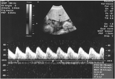 IUGR: screening Biometria ecografica e Stima del Peso Fetale (I trimestre, 20-22 settimane, 30-32 settimane) Flussimetria Doppler Lunghezza sinfisi fondo Management dell IUGR La Velocimetria Doppler