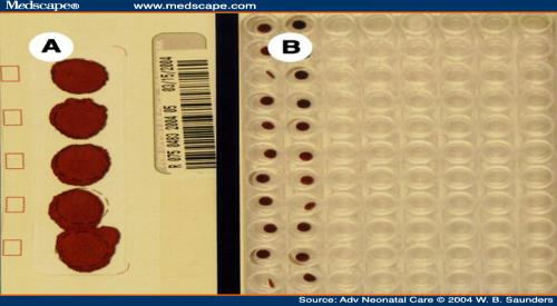 MALATTIA DI POMPE PERCHE E IMPORTANTE FARE LA DIAGNOSI E TRATTARE?