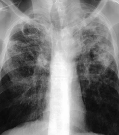 Diagnosi di tubercolosi Diagnosi di malattia attiva Esami radiologici il sospetto iniziale di TB è spesso basato su anomalie radiografiche in soggetti con sintomi