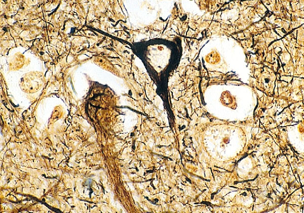 Fusi Neurofibrillari I fusi Neurofibrillari sono aggregati