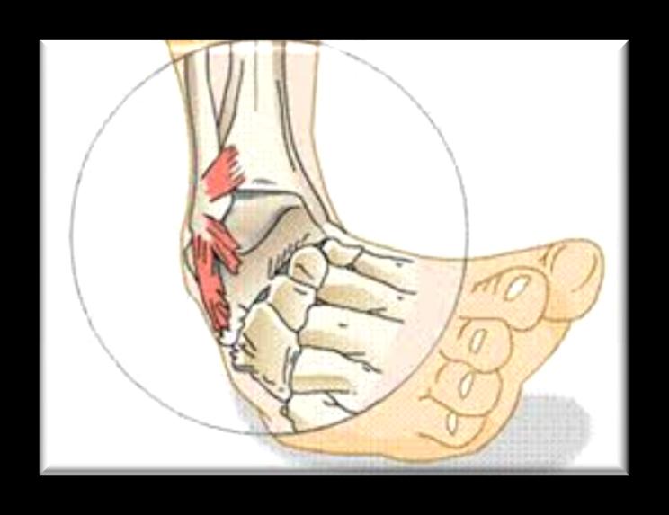 Inversione Causa più spesso lesioni ai legamenti laterali. Meno frequenti sono invece le fratture malleolari. Rappresenta l 85% dei casi di distorsione.