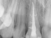 La sequenza dell irrigazione in Endodonzia Philippe Sleiman, DDS Fadl Khaled, DDS Figura 1 Un incisivo centrale trattato in due sedute: la polpa era necrotica ed era presente una tumefazione.