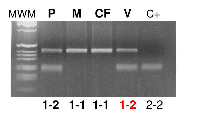 Diagnosi prenatale di CF mediante analisi di linkage MetH: extragenico, ~1Mb L allele 2 del padre è normale Quale degli alleli della madre?