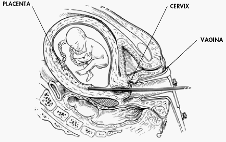VILLOCENTESI 10a-11a settimana di gravidanza placenta cervice vagina Villocentesi
