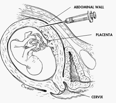 VILLOCENTESI 10a-11a settimana di gravidanza parete addominale placenta cervice