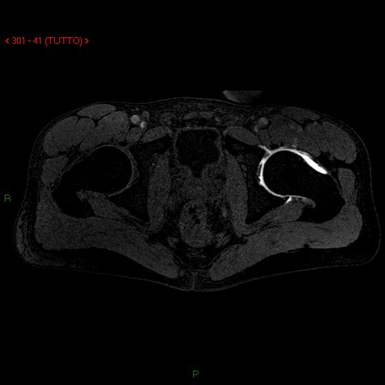 Artrografia RM (mdc intrarticolare) Studio labbro acetabolare e cartilagine femorale e