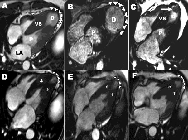 Appunti di Cardiochirurgia Capitolo 7 Cardiopatia ischemica pagina- 10-7.6-7 fasi evolutive e schema del rimodellamento del ventricolo Sinistro con aneurisma.