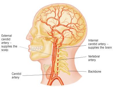 SOTTOTIPI EZIOLOGICI CLASSIFICAZIONE TOAST* ( Stroke, 1993) ATEROSCLEROSI GROSSI VASI 15-40% CARDIOEMBOLICO