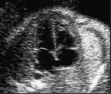 Valutazione ecografica del cuore fetale