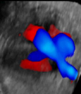 Confermare la presenza/assenza di anomalie cardiache Caratterizzare l anomalia Obiettivi principali: Accurata diagnosi differenziale dei difetti più probabili Identificare i feti che richiedono