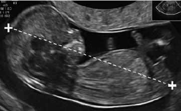 Vitalità Misure fetali Datazione Valutazione anatomia fetale Valutazione anomalie