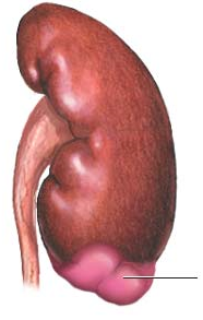 l impostazione terapeutica. Nel 4-10% dei casi di carcinoma, la diagnostica per immagini rileva un estensione nella vena che si può estendere fino alla vena cava. FIG. 5 Enucleoresezione COME SI CURA?