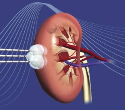 Trattamenti alternativi sono la crioablazione (Fig. 7), l ablazione con radiofrequenza (RF), con microonde, con il laser, o gli ultrasuoni ad alta intensità (HIFU).