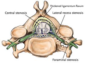 STENOSI DEGENERATIVA DEL CANALE CERVICALE Alterazioni anatomiche peculiari Degenerazione del disco