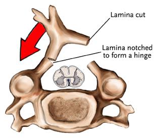Approccio Posteriore Laminectomia e Laminoplastica (1984) Sono le tecniche più utilizzate per la decompressione parziale o completa del midollo