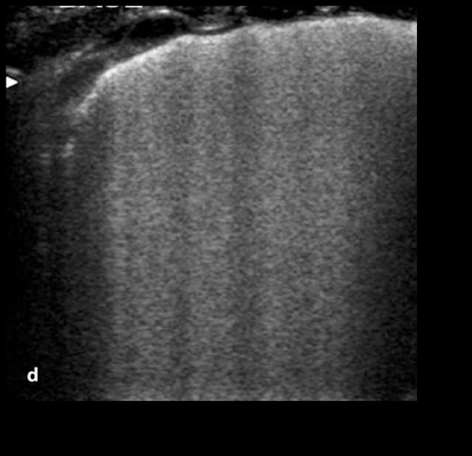 La sindrome interstiziale è caratterizzata dalla presenza di molte linee B Nella sua espressione più lieve, le linee B sono distanti tra loro 7 mm.