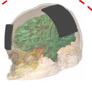 Elettrodi sullo scalpo inviano corrente elettrica debole (tra 1 e 2 ma) nel cervello