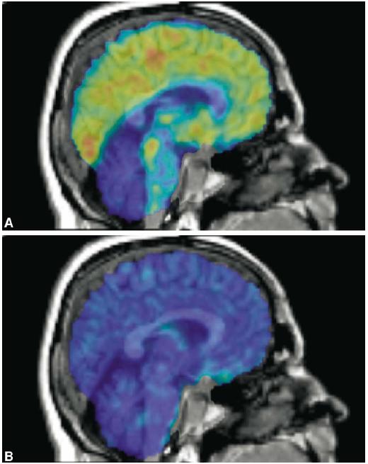 Aprepitant blocca i recettori NK1 localizzati nel cervello Legame del tracciante PET ai recettori NK-1 prima del