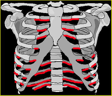 PNEUMOTORACE IPERTESO GRAVE DISPNEA