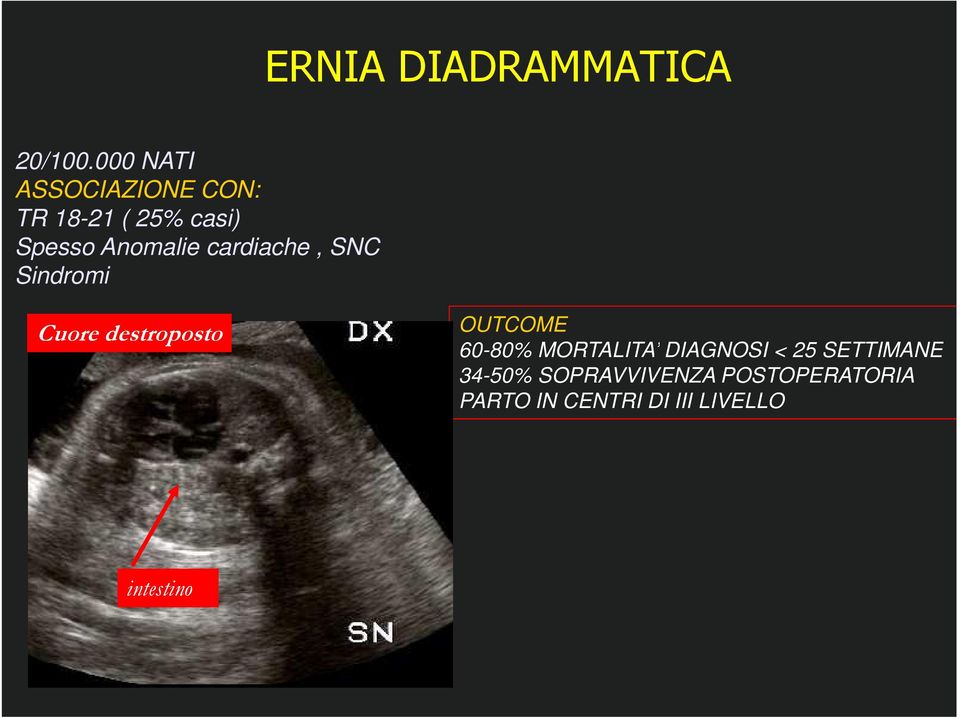 cardiache, SNC Sindromi Cuore destroposto OUTCOME 60-80%