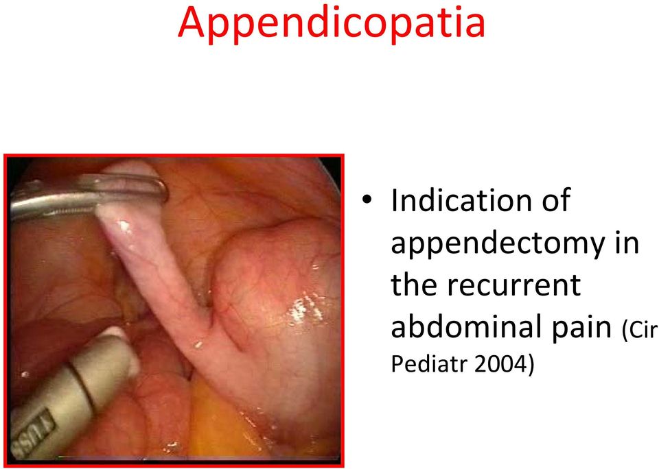 appendectomy in the