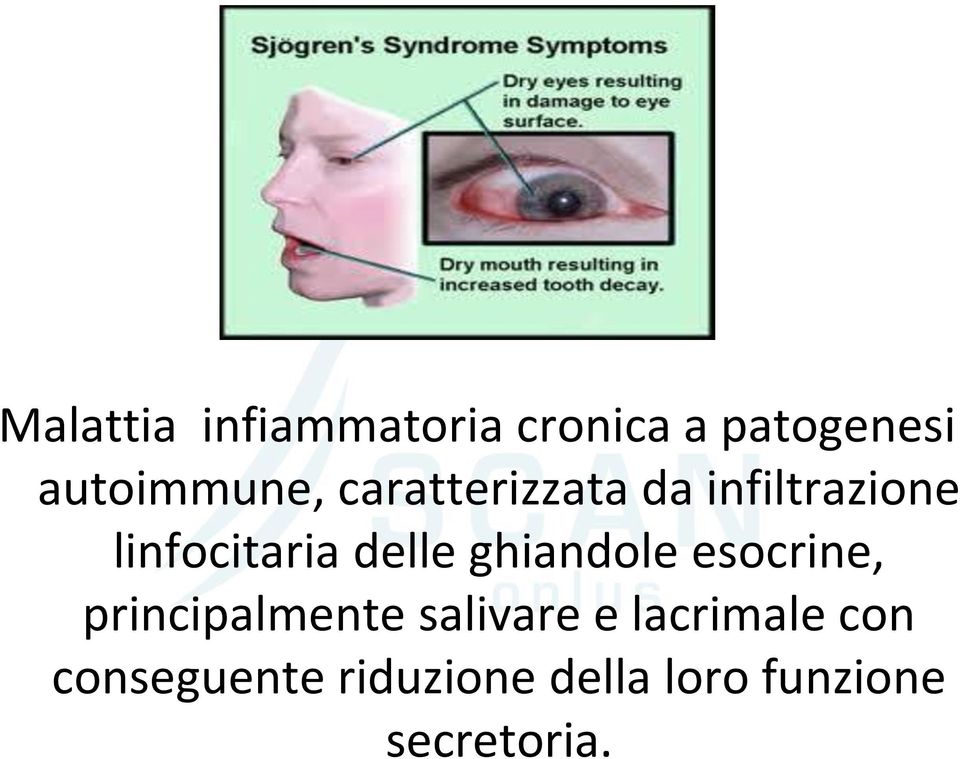 linfocitaria delle ghiandole esocrine, principalmente