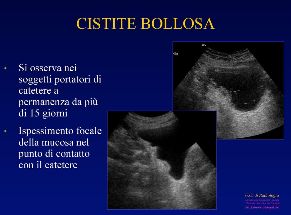 di 15 giorni Ispessimento focale della