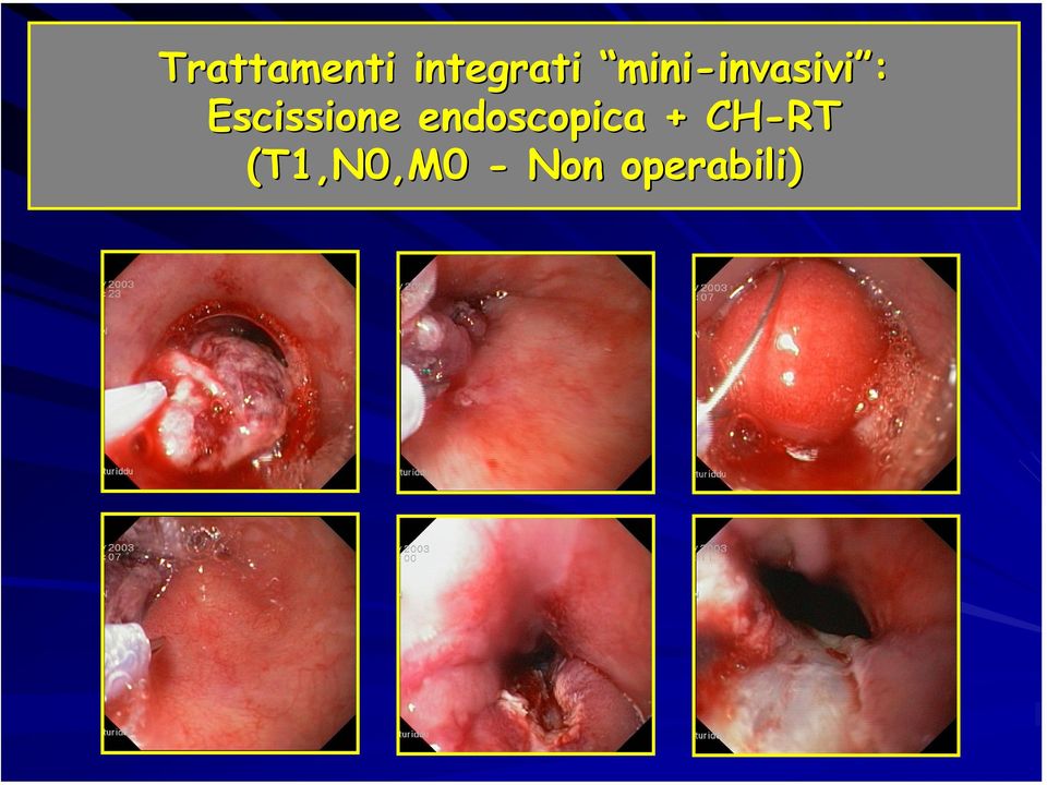 Escissione endoscopica +