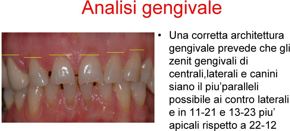 e canini siano il piu paralleli possibile ai contro