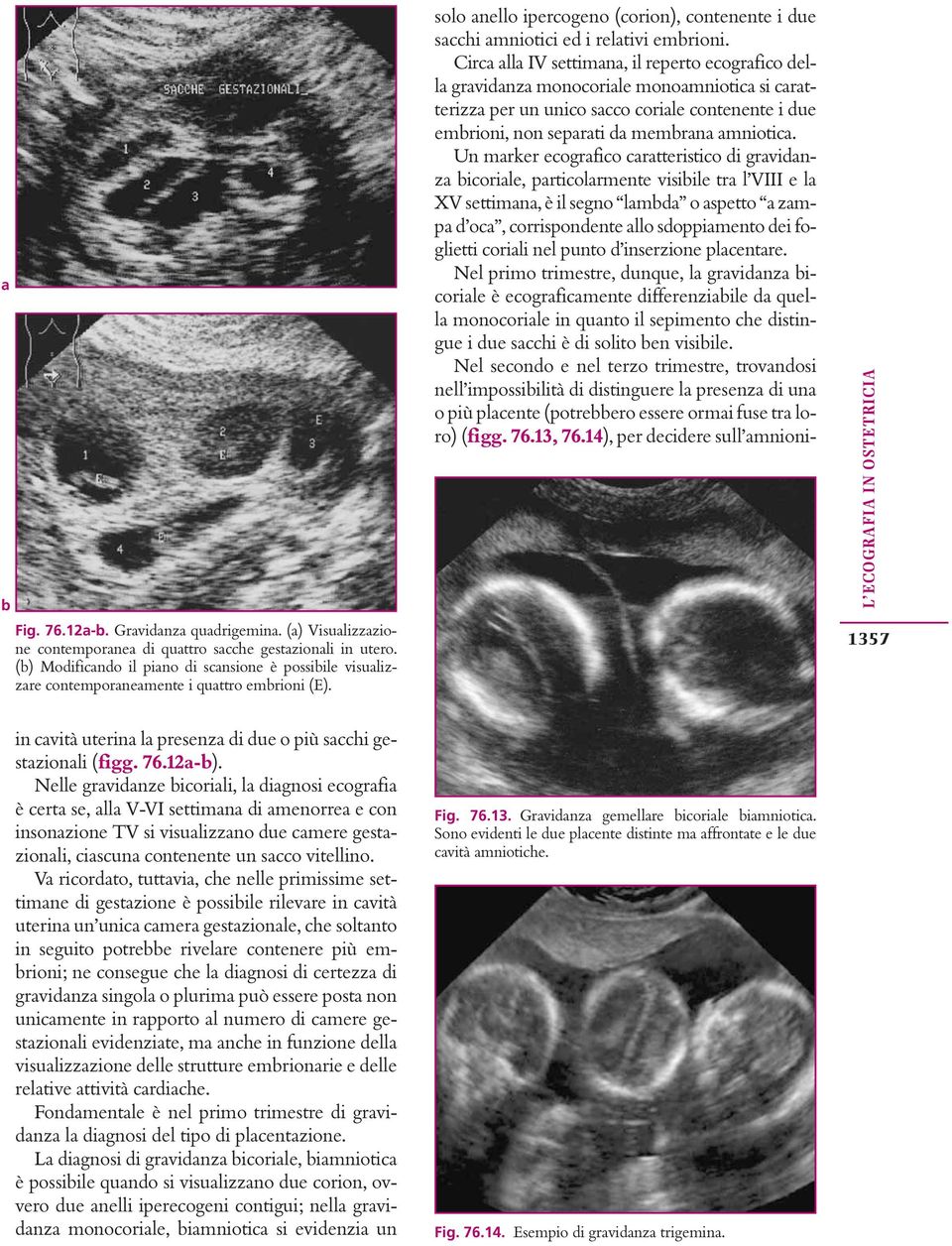 Circa alla IV settimana, il reperto ecografico della gravidanza monocoriale monoamniotica si caratterizza per un unico sacco coriale contenente i due emrioni, non separati da memrana amniotica.
