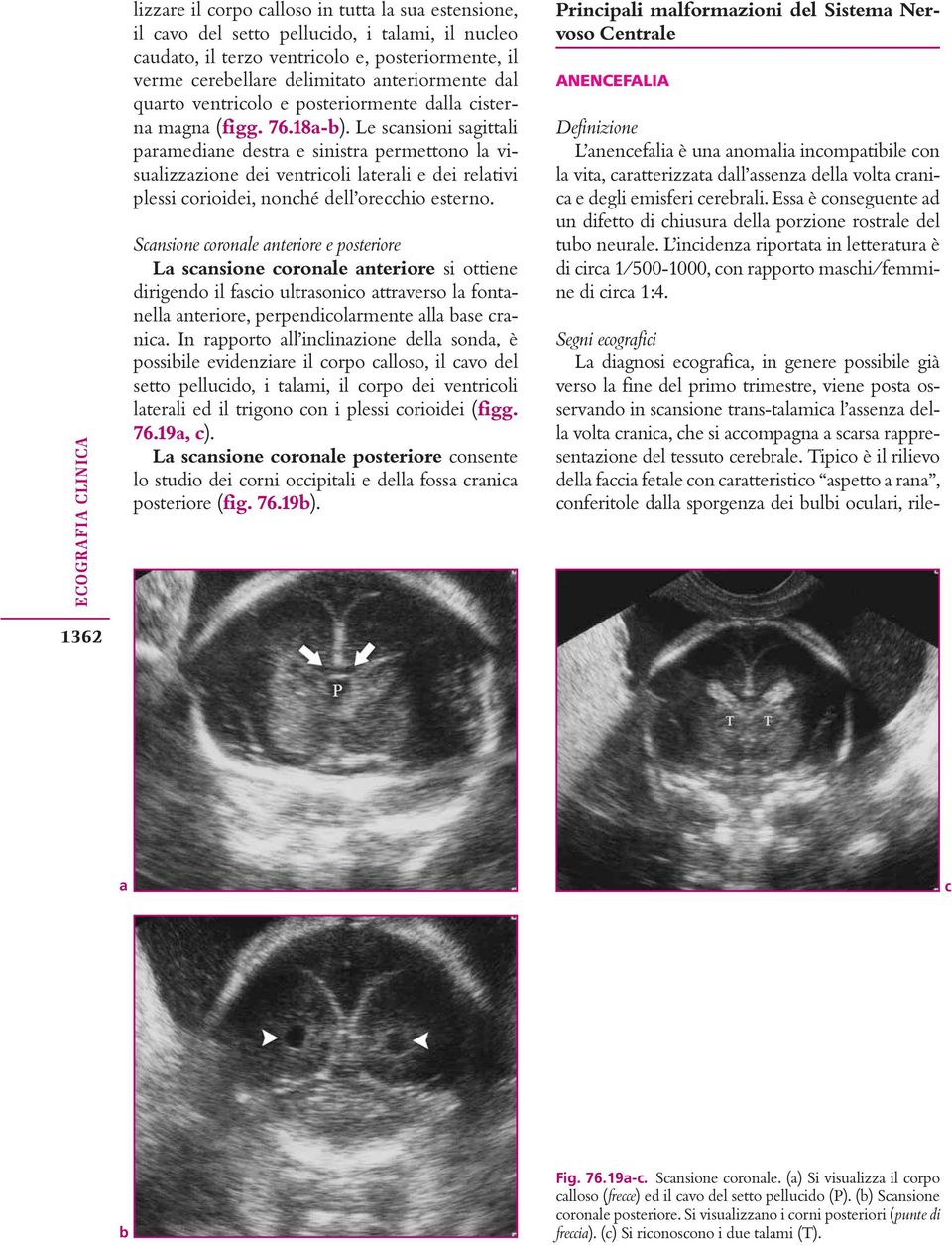 Le scansioni sagittali paramediane destra e sinistra permettono la visualizzazione dei ventricoli laterali e dei relativi plessi corioidei, nonché dell orecchio esterno.