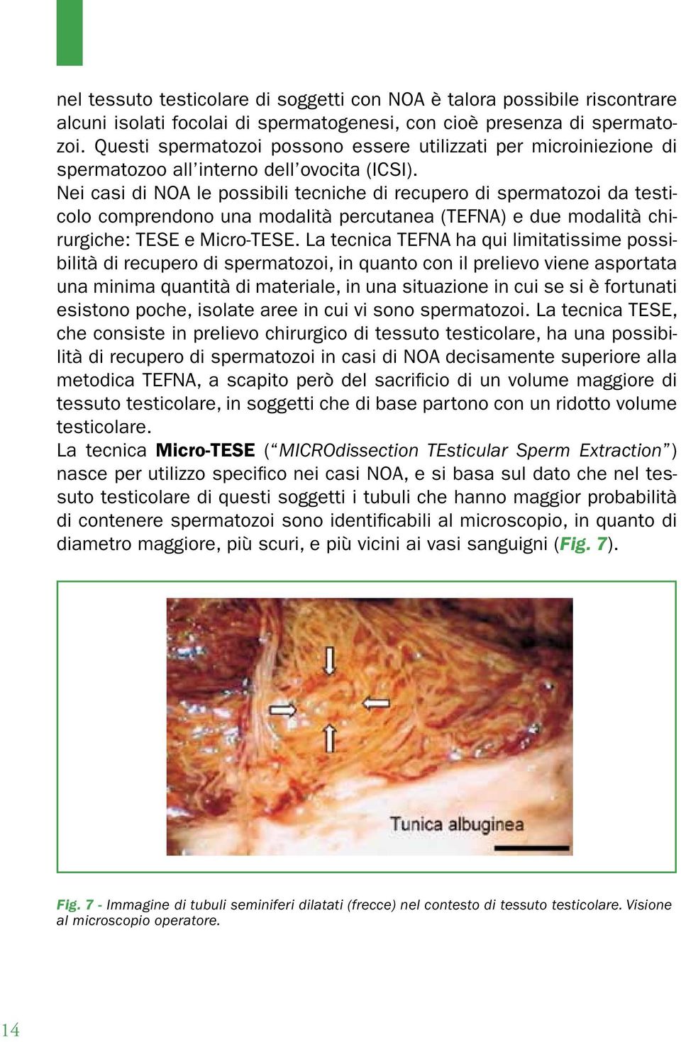 Nei casi di NOA le possibili tecniche di recupero di spermatozoi da testicolo comprendono una modalità percutanea (TEFNA) e due modalità chirurgiche: TESE e Micro-TESE.