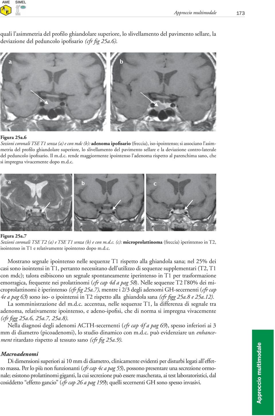 la deviazione contro-laterale del peduncolo ipofisario. Il m.d.c. rende maggiormente ipointenso l adenoma rispetto al parenchima sano, che si impregna vivacemente dopo m.d.c. a b c Figura 25a.