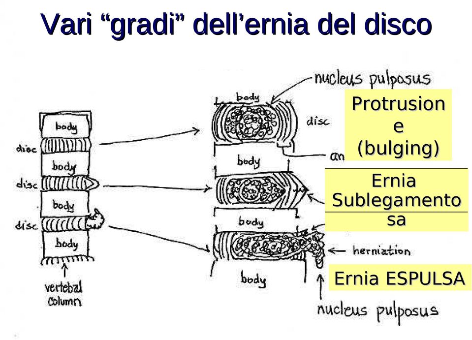 (bulging) Ernia