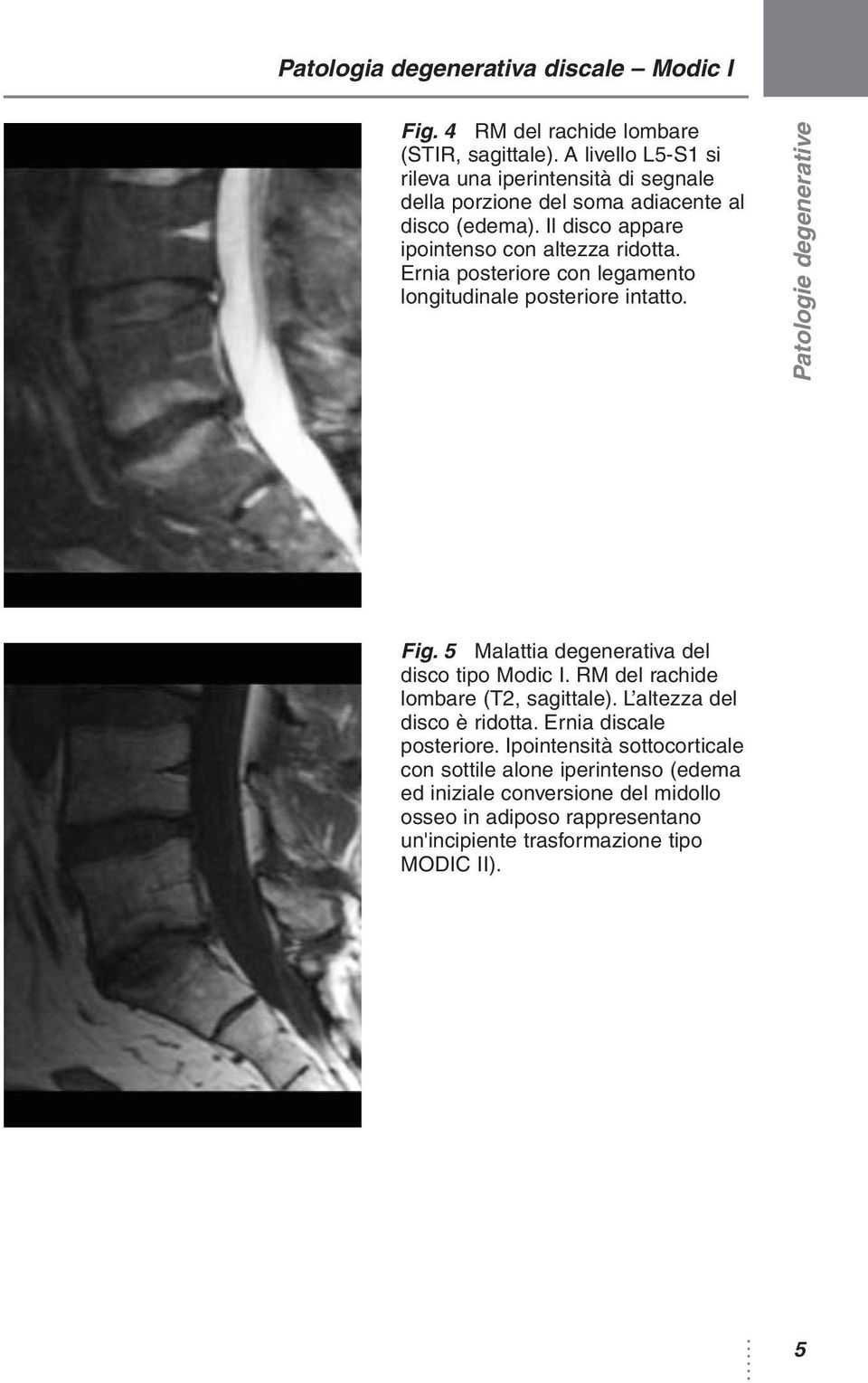 Ernia posteriore con legamento longitudinale posteriore intatto. Fig. 5 Malattia degenerativa del disco tipo Modic I. RM del rachide lombare (T2, sagittale).