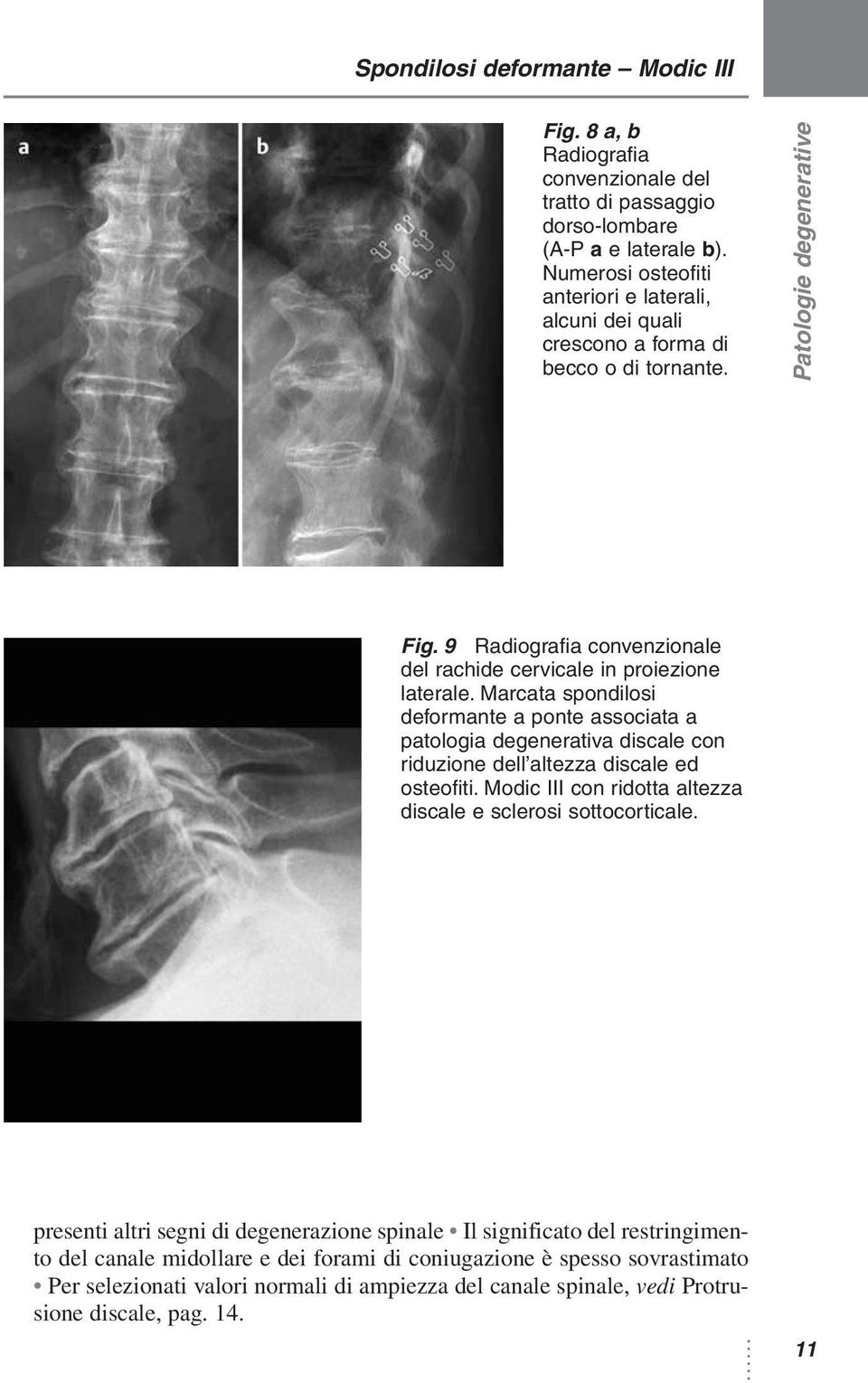 Marcata spondilosi deformante a ponte associata a patologia degenerativa discale con riduzione dell altezza discale ed osteofiti.