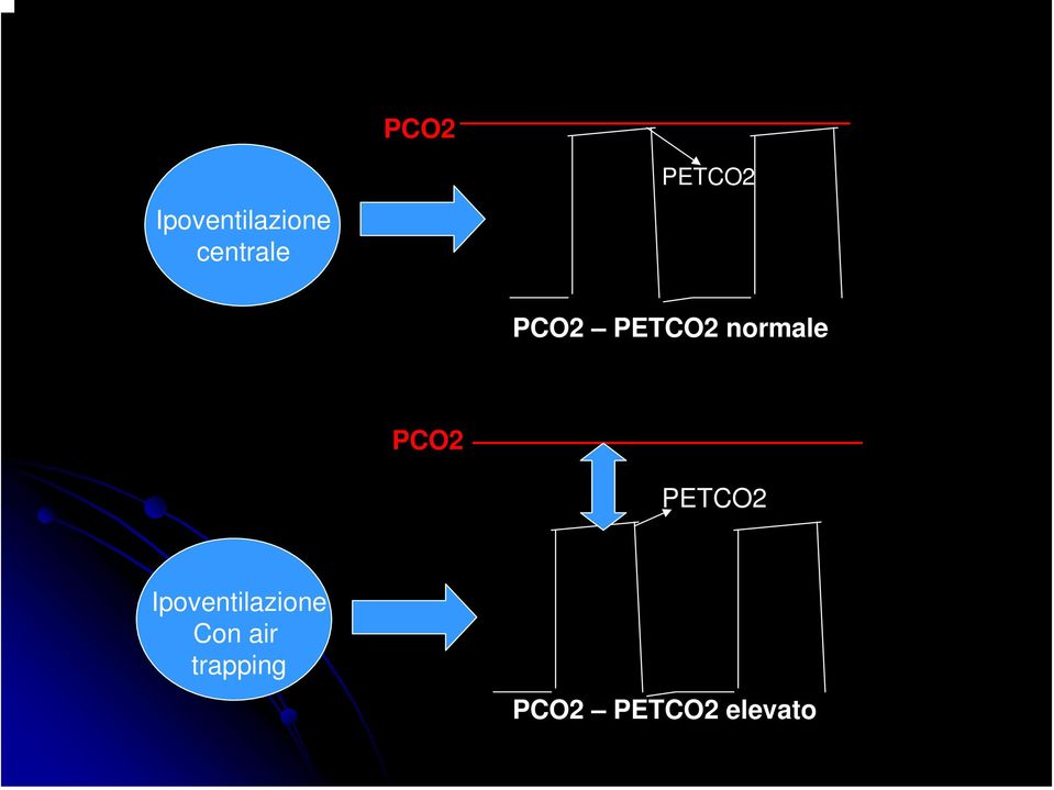 PCO2 PETCO2 Ipoventilazione