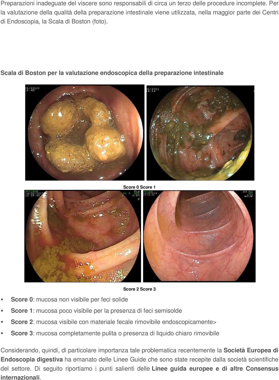 Scala di Boston per la valutazione endoscopica della preparazione intestinale Score 0 Score 1 Score 2 Score 3 Score 0: mucosa non visibile per feci solide Score 1: mucosa poco visibile per la