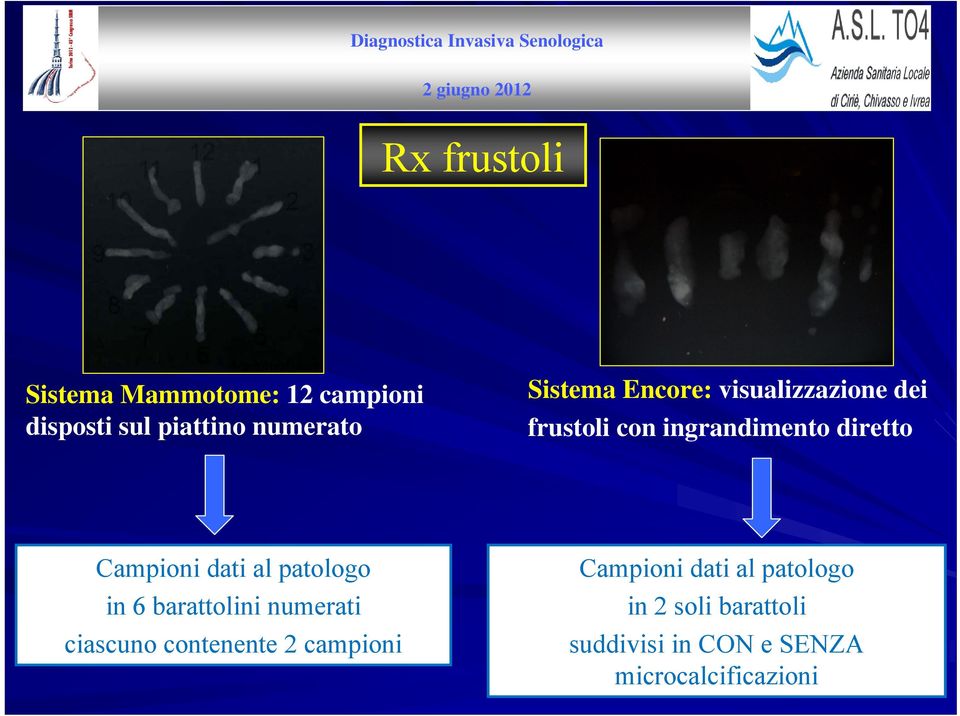 dati al patologo in 6 barattolini numerati ciascuno contenente 2 campioni