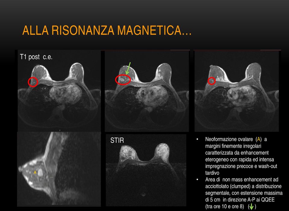 enhancement eterogeneo con rapida ed intensa impregnazione precoce e wash-out tardivo Area