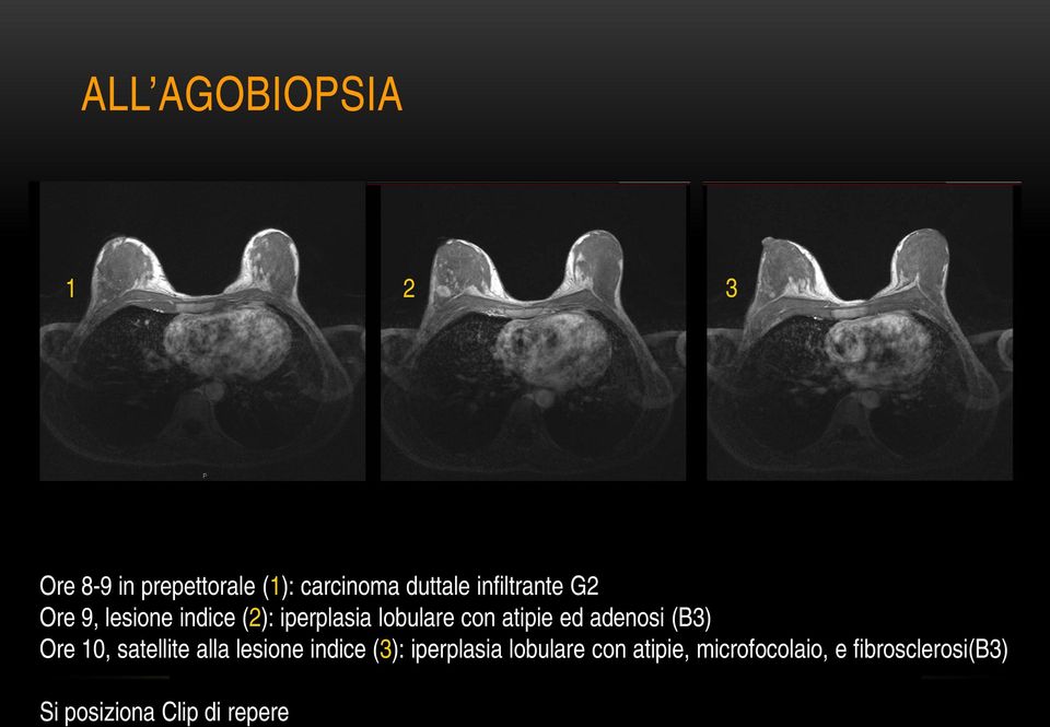 ed adenosi (B3) Ore 10, satellite alla lesione indice (3): iperplasia
