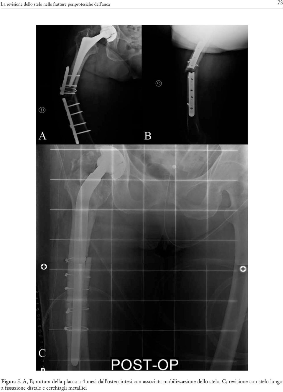 A, B; rottura della placca a 4 mesi dall osteosintesi con